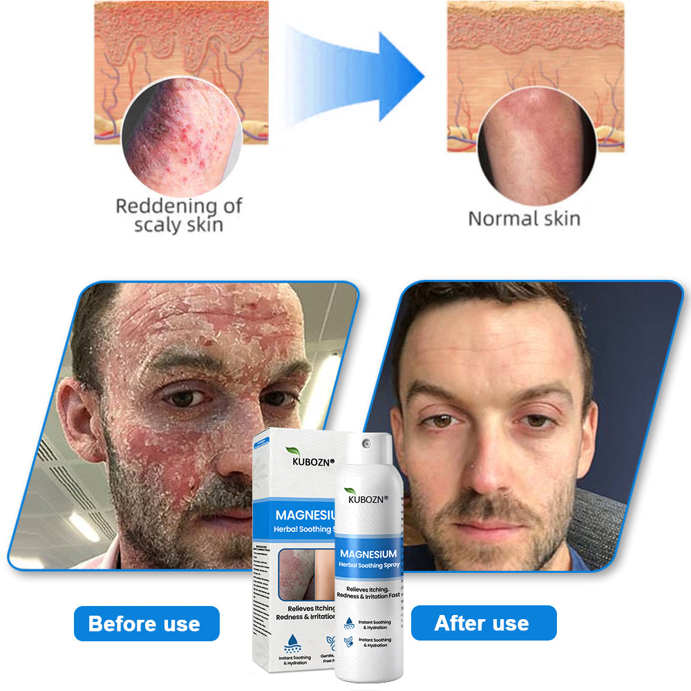 J✅ Official Store:KUBOZN® Magnesium Herbal Spray – Fast Relief for Psoriasis & Eczema | No-Rub, Steroid-Free