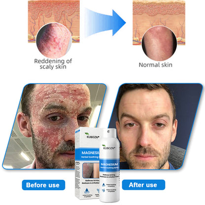 J✅ Official Store:KUBOZN® Magnesium Herbal Spray – Fast Relief for Psoriasis & Eczema | No-Rub, Steroid-Free