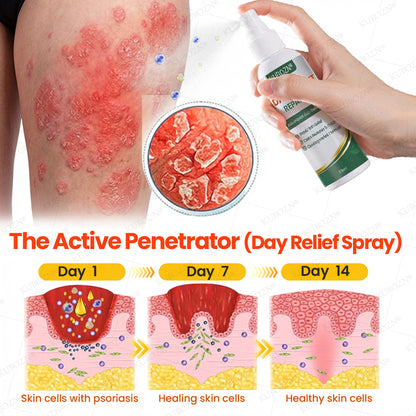 🇭✨KUBOZN® Psoriasis Day & Night Repair System - 100% Steroid-Free Relief Duo for Plaques, Scaling & Itch