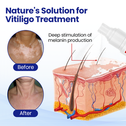 🇭🌿KUBOZN® Vitiligo Repigmentation Spray — Visible Results in 7 Days, Steroid-Free