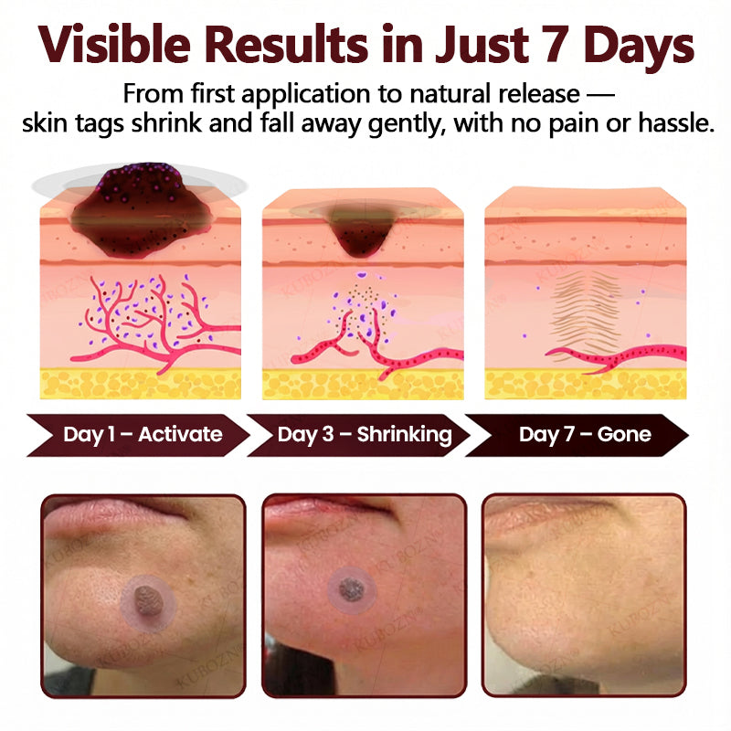 KUBOZN® OryzaDarts TAG’GONE Patch✨Pain-Free Root-Level Removal Powered by Black Rice MicroDarts. (offer)