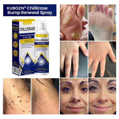 🇭 KUBOZN® ChillErase Cooling Spray for Skin Tags